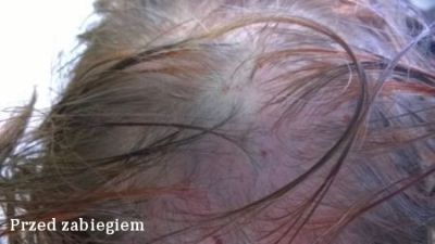 Terapia osoczem bogatopłytkowym